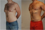 Male Before and After Lipo Chest and Abdomen