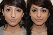Rhinoplasty Surgery. 1 month post-op.