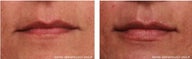 50 Year Old Woman treated for Lip Enhancement
