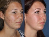 PDT & Fraxel Restore Before and After