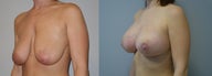 Breast augmentation and a breast lift