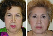 Facelift