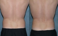 Zeltiq for fat reduction on "love handles"