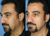 52 year old Gentleman rhinoplasty patient