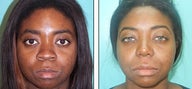 Nose Job- Rhinoplasty