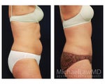 Liposuction