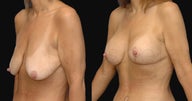 Breast lift after weight loss