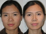 Asian Rhinoplasty