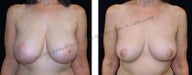 Breast Lift