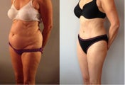 Abdominoplasty / Tummy Tuck Before & After