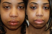 Lip Reduction Surgery.