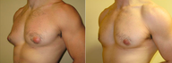 Male Breast Reduction