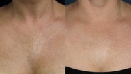 Sculptra Before and After