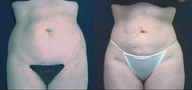 Liposculpture