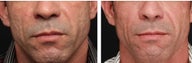Acne scar treatment
