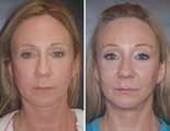 Facelift