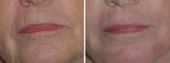 Laser Resurfacing