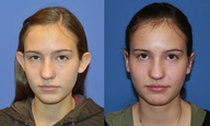 Otoplasty