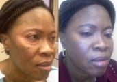 50 Year Old Lady Treated for Eyelid Bags