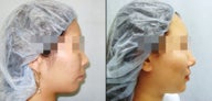 Chin Augmentation
