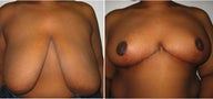 45 year old woman who underwent breast lift