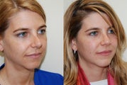 Revision Rhinoplasty Surgery. 8 months post-op.