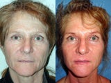Lower Lid Blepharoplasty and the SLUPlift