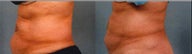 CoolSculpting Results