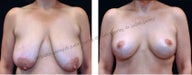 Breast Lift