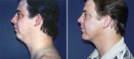 Chin Augmentation