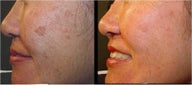 Before and After Photofacial IPL for Pigment Removal