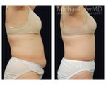 Liposuction