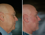Facelift