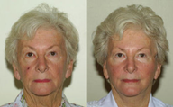 Face and Neck Lift