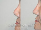 Asian Revision Rhinoplasty – Pollybeak Deformity