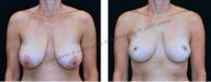 Breast Lift