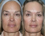 Fraxel Repair for sun damage and wrinkles