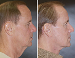 Facelift