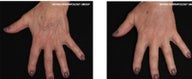 Hand Rejuvenation with Perlane