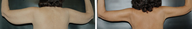 Arm Lift