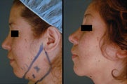 Chin / Neck Liposuction