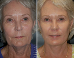 Laser Resurfacing