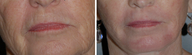 Laser Resurfacing