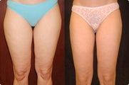 Smart Lipo: Inner Thigh Area