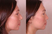Rhinoplasty