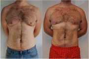 Male Before and After Lipo Chest and Abdomen