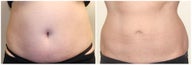 Coolsculpting