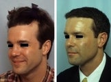 Hair replacement with Fleming/Mayer flap