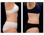 Liposuction
