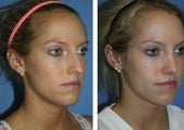 Rhinoplasty